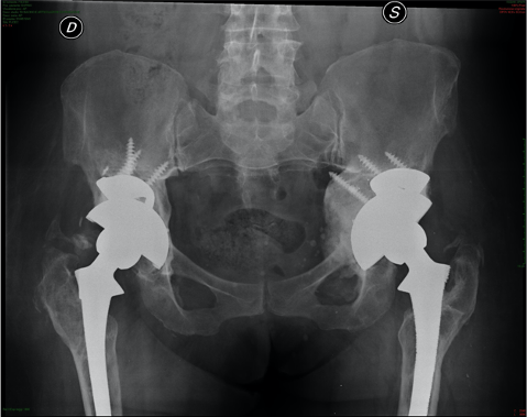 immagine protesi anca