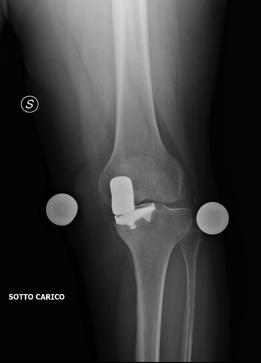 protesi ginocchio1
